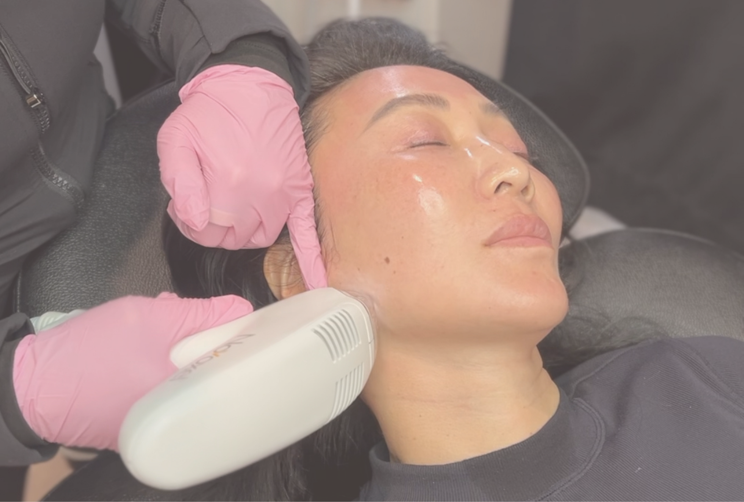 Tixel skin resurfacing at Destination Aesthetics
